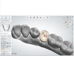 DentalSystem – Design di un elemento singolo su dente naturale: elemento 4.5