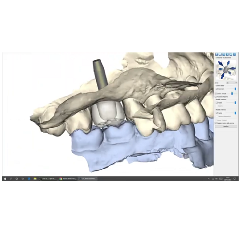 Il dente singolo su impianto – Atlantis Workflow