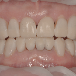 Caso grave di dentizione usurata: protocollo full digital