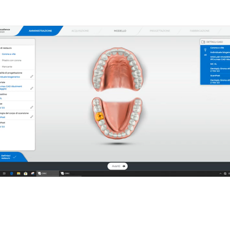 Fase di amministrazione per corona avvitata su impianto con SW Cerec 5.0.2