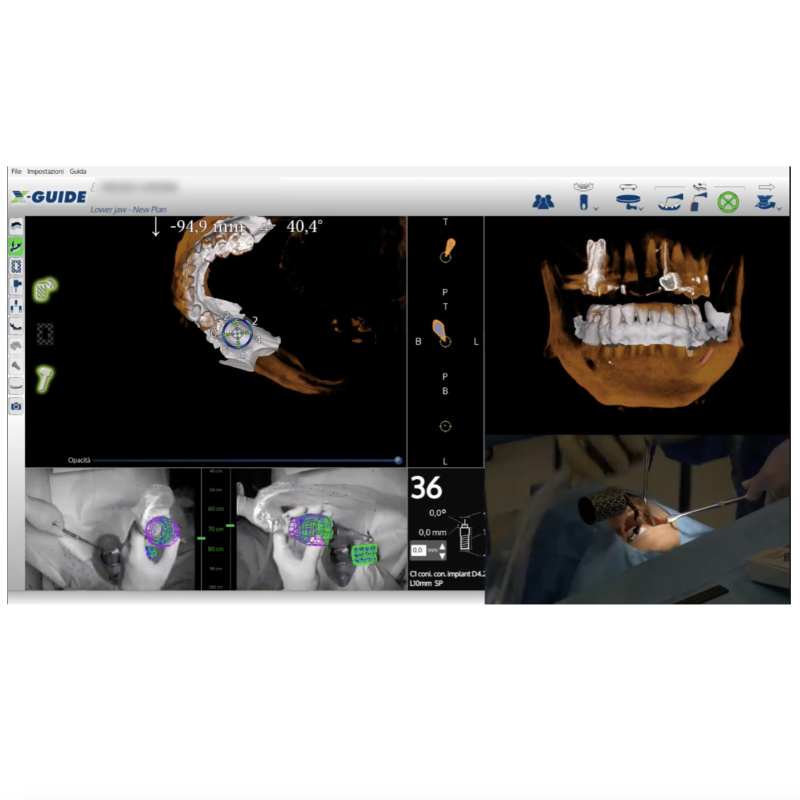 Indicazioni all’uso della chirurgia a navigazione 3D in implantologia