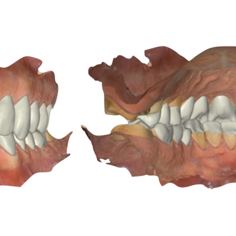 La Sindrome della Dentizione Usurata: soluzioni mini-invasive semplificate