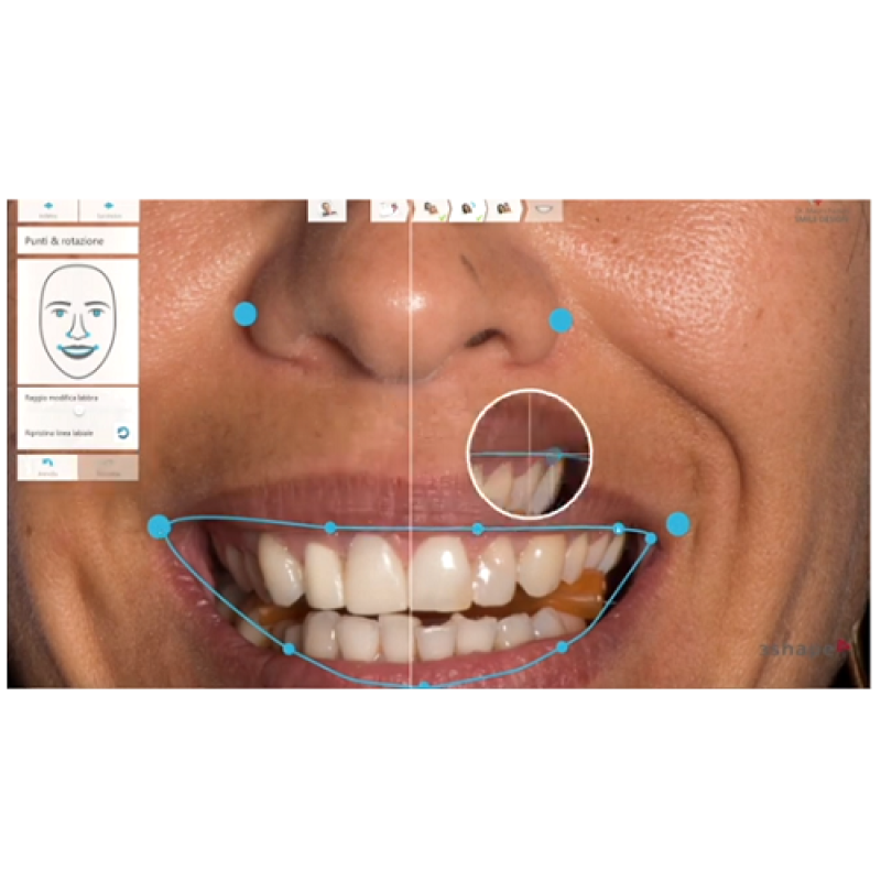 Trios di 3Shape: progettazione di un caso di Smile Design