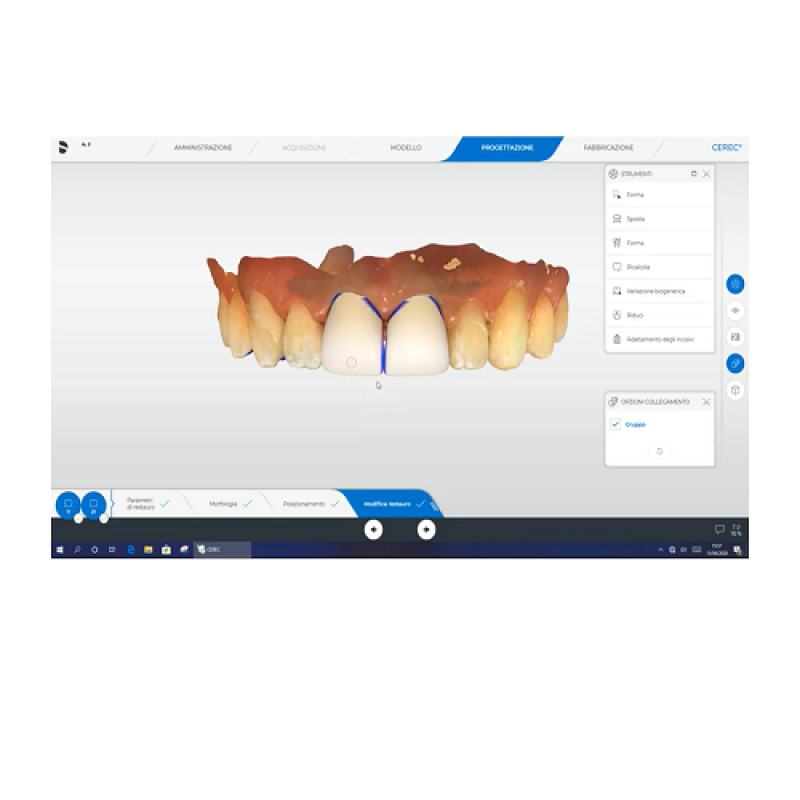 Progettazione di elementi singoli anteriori su denti naturali: 1.1 e 2.1