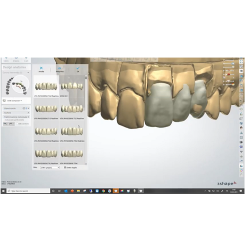 DentalSystem – Design di un ponte a 3 elementi nel settore Anteriore: 2.1-2.2-2.3