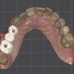 Implantologia digitale – Ponte 3 elementi con chirurgia robotica Xnav