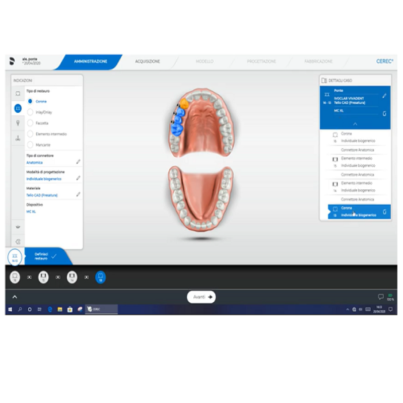 Fase di amministrazione per restauro ponte con SW Cerec 5.0.2