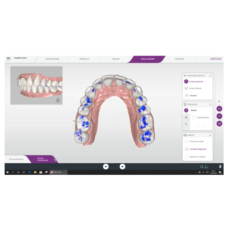 Simulazione del Modello per Trattamento Ortodontico