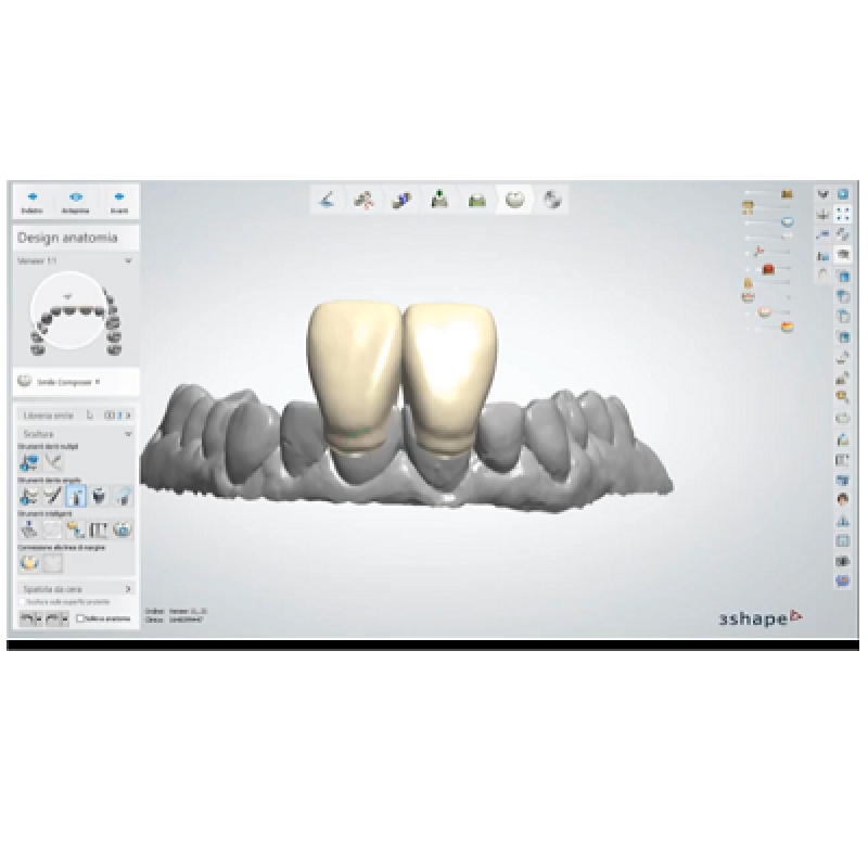 DentalSystem – Design di faccette frontali